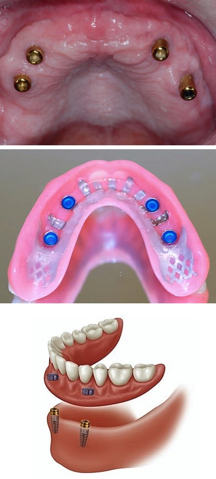 Dentures Implants San Miguel NM 88058
